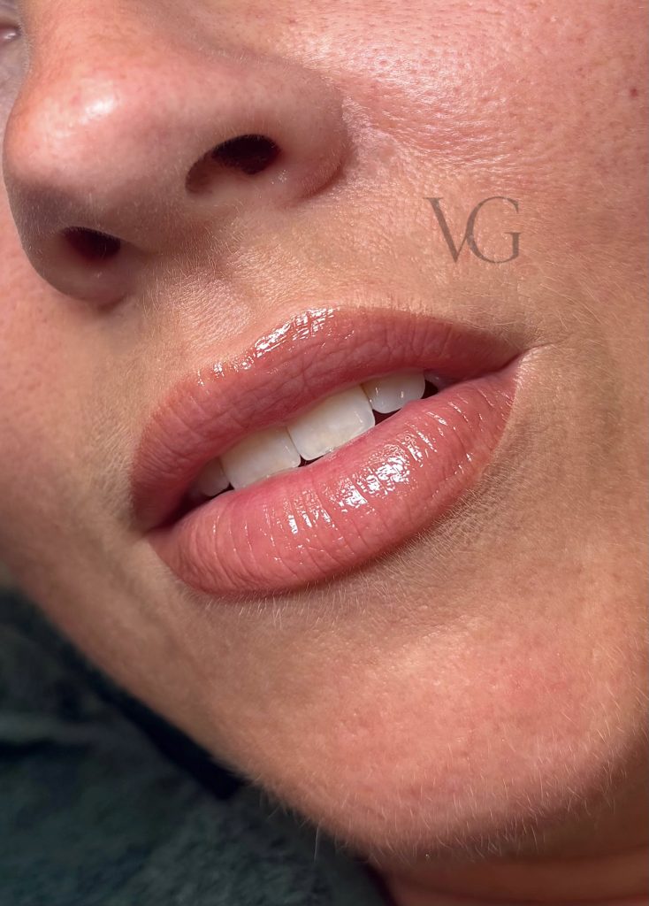 Lippen Teilschattierung (abgeheilt)